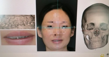 “脸歪”女子正畸后重塑自信面容 专家揭秘牙齿矫正奥秘